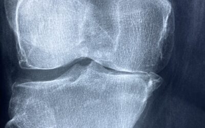 Microfracture Surgery –  6 Positive Benefits backed by Scientific Evidence to Revitalise your Joints